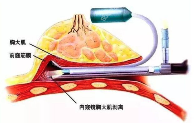 广州中家医隆胸到底选哪个医生好