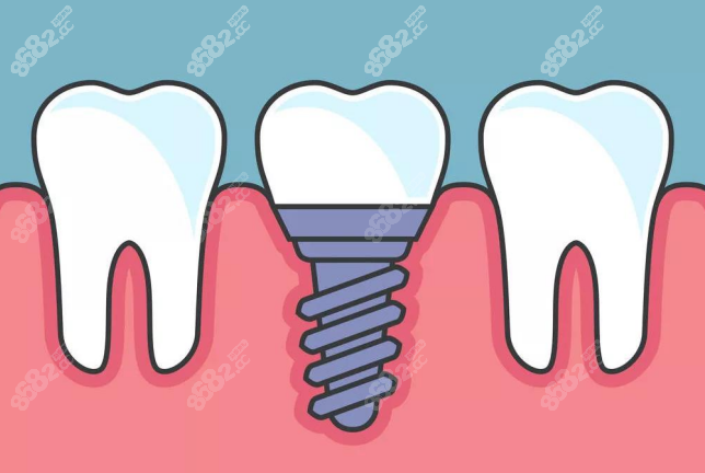 上海鼎植口腔种植牙