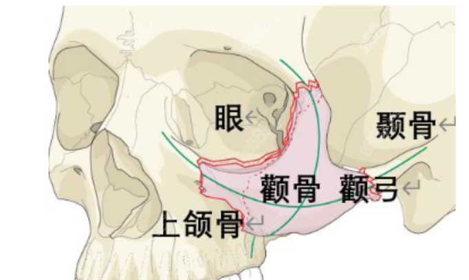 黄大勇做颧骨手术