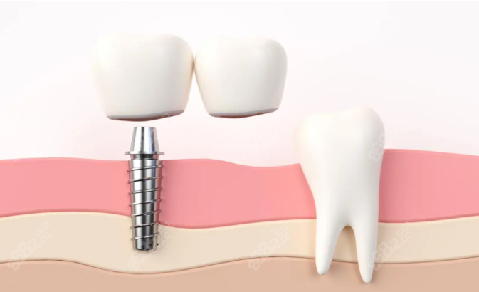 8682.cc鼎植口腔种植牙