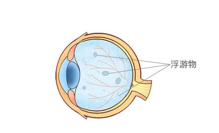 飞蚊症漂浮物
