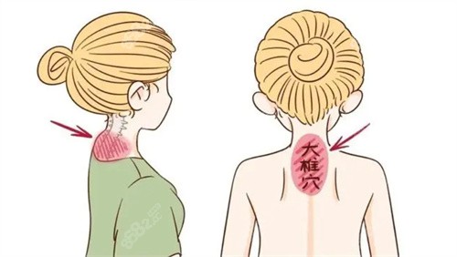 北京嘉禾整形医院做富贵包手术好吗