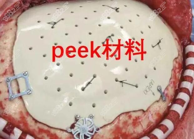 用peek修补颅骨技术成熟了吗？