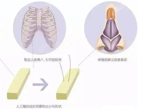 广州曙光医疗美容刘杰伟半肋综合隆鼻技术娴熟