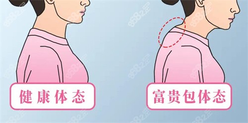 北京嘉禾整形医院做富贵包手术好吗