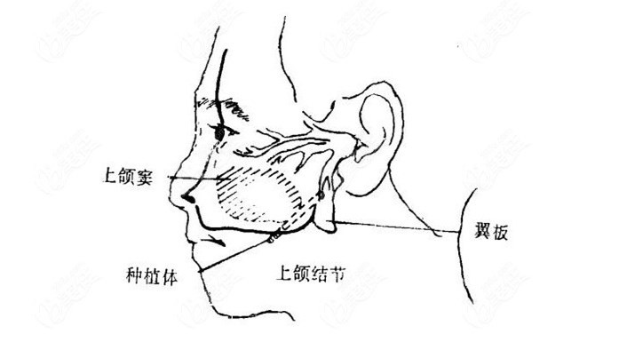 穿翼板种植牙更稳固