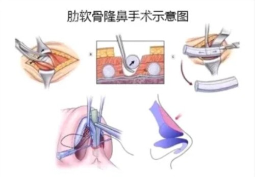 广州曙光医疗美容刘杰伟医生做生态半肋综合隆鼻的技术高超