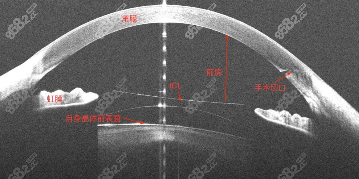 我做icl的血泪教训:一定要做详细的术前评估避免出现并发症