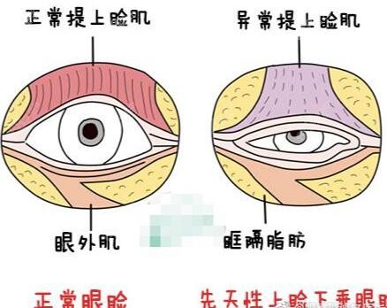 杜园园眼睑修复
