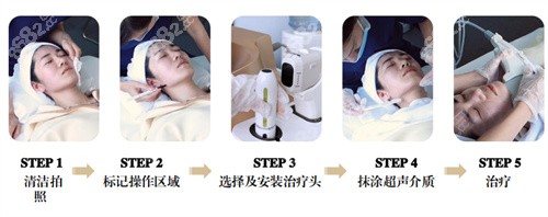 尖峰超声王多久可以看到成效
