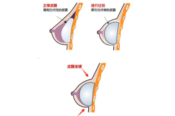 林沸腾医生做隆胸手术是双平面的技术