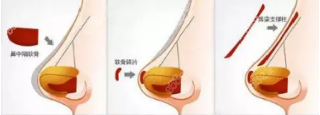 华美叶丽萍做鼻子