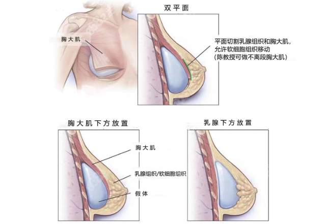 林沸腾医生隆胸属于双平面技术