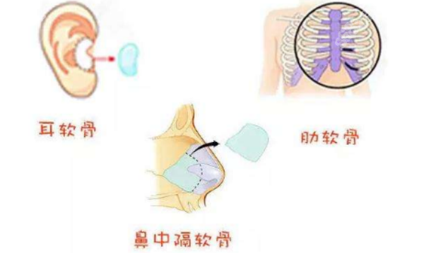 8682.cc广州曙光程鹏医生做隆鼻手术