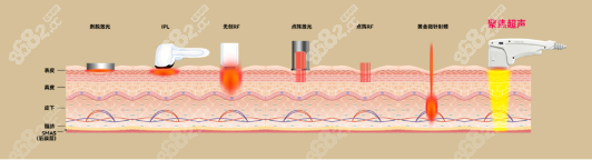 尖峰超声王值得做