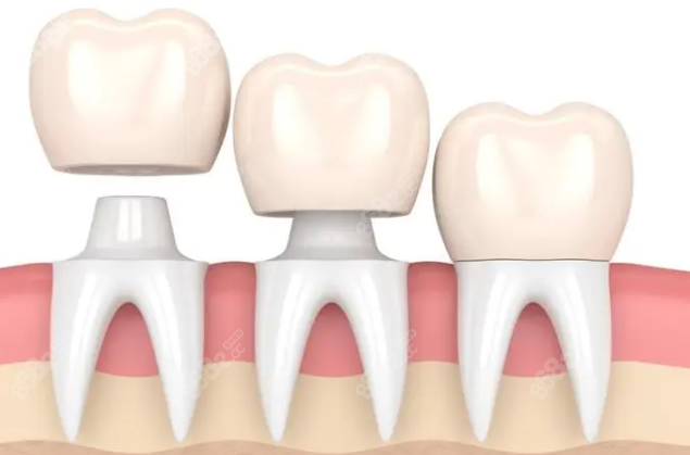 北京东直门牙冠价格参考东直门附近好的口腔牙冠收费