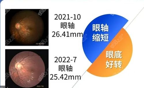 <!--<i data=20240705-sp></i>-->4l疗法几个月能见结果