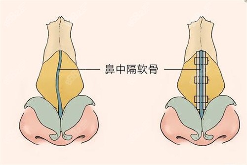 隆鼻怎么样叫增生了