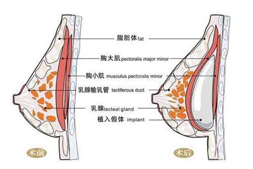 假体隆胸手术怎么样