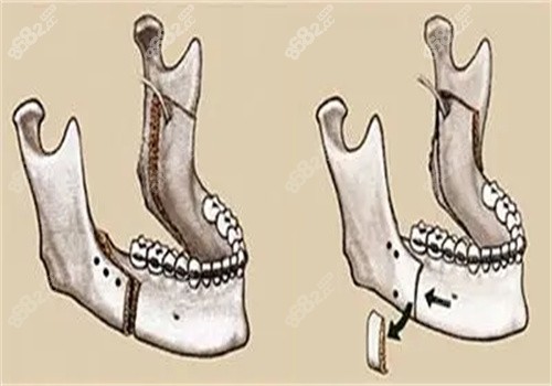 正颌手术单颌双颌区别怎么判断
