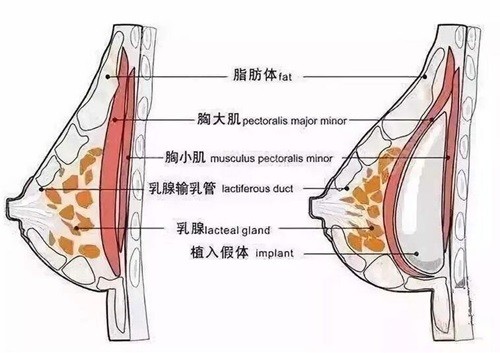 上海华美特贝茨假体隆乳术