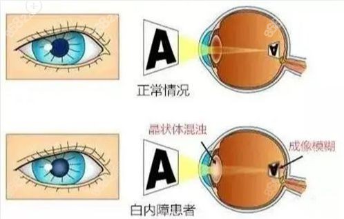 飞秒白内障用医疗保险能报销