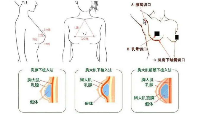 郝永生医生做隆胸手术确实好