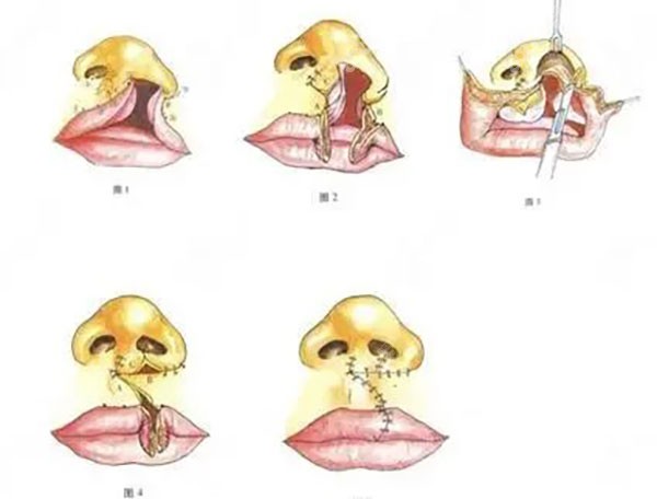 唇腭裂修复