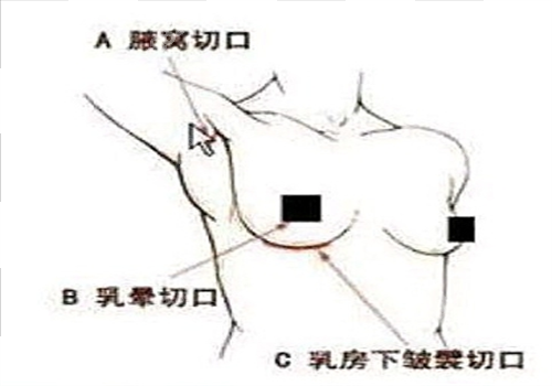 北京美莱医疗美容医院假体隆胸手术切口图