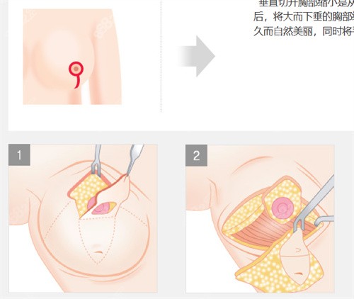 韩国格瑞丝噢爱美缩胸剥离切开