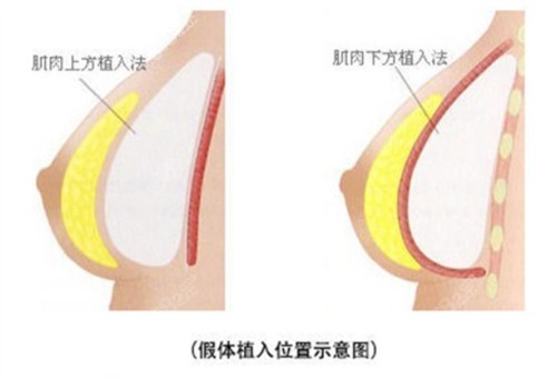 广州李<!--<i data=20240705-sp></i>-->是做内窥镜动感隆胸技术娴熟