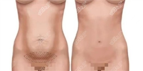 腹壁成型术适用人群