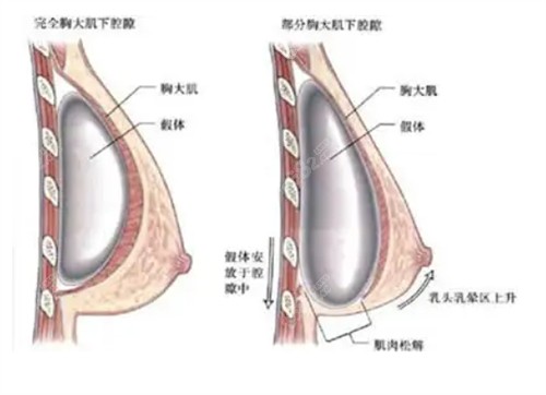 李<!--<i data=20240705-sp></i>-->医生做假体隆胸口碑好