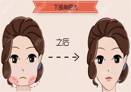 金柱翰顴弓內推價格是多少