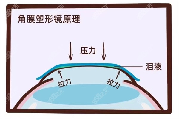 角膜塑形镜没有被美国禁止