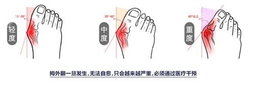 拇外翻手术苏敬达大夫怎么样