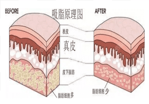 北京八大处整形医院吸脂手术图