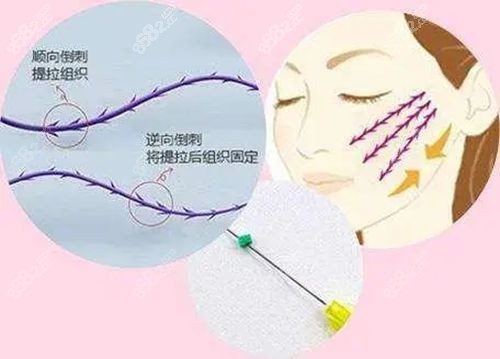 青春肽支架面部提升手术价格多少