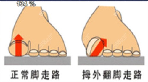 北京圣嘉新拇外翻