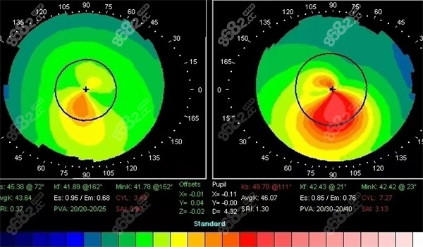 角膜地形图