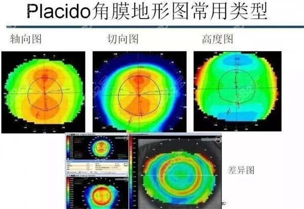 角膜地形图的原理