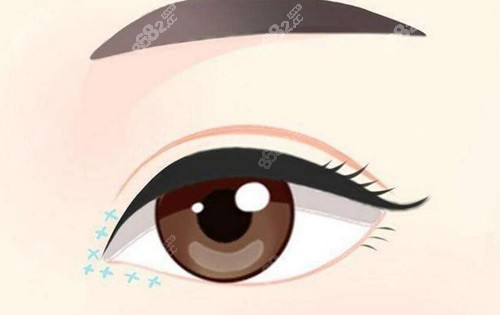 韩国大眼睛整形医院修复双眼皮