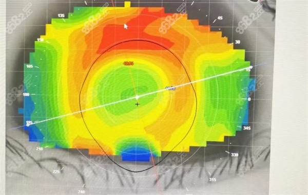 角膜地形图引导有必要吗