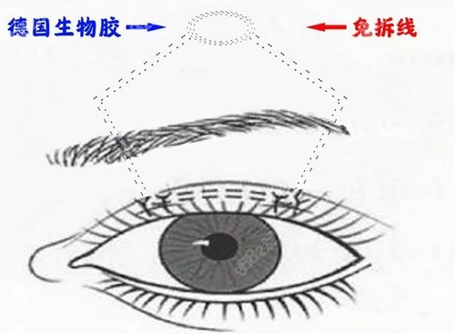 北京美和眼科MTS微创硅胶悬吊技术介绍