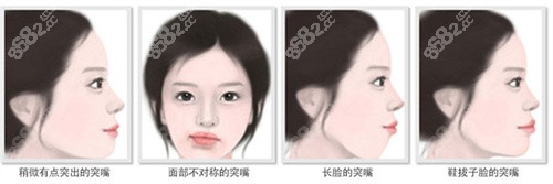 faceline院长李真秀价格（适合双鄂手术的示意图）