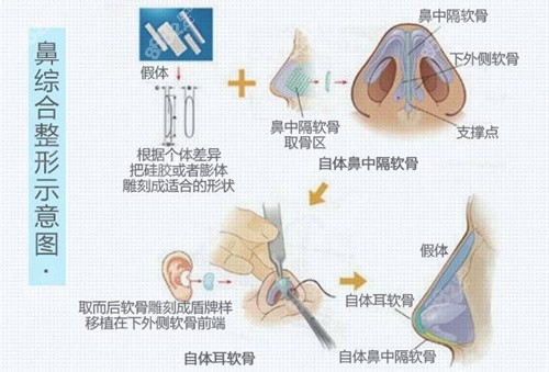 杭州艺星整形医院隆鼻流程