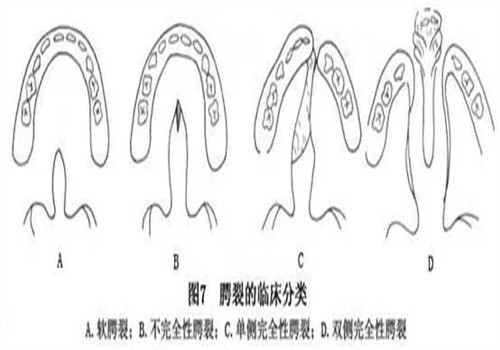 腭裂的影响