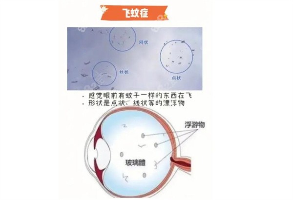 近视眼飞蚊症能自愈吗？