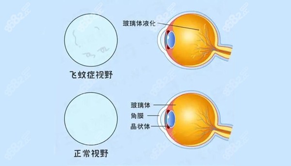 近视眼飞蚊症能自愈吗？