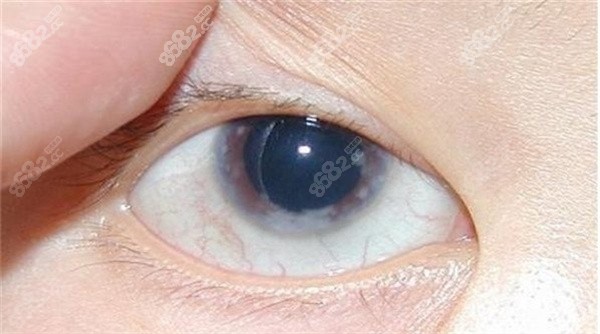 青光眼病变在眼球什么位置